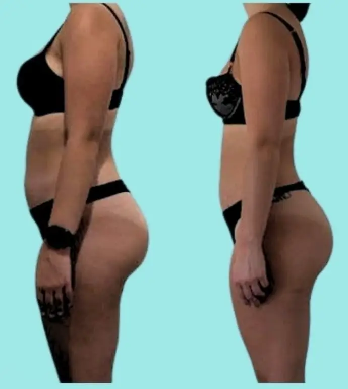 Before and after of a client: both sides show a side view against a teal background in a black bra and dark briefs, left with a smartwatch on the wrist.